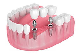 Digital diagram of an implant bridge replacing multiple missing teeth in Dallas