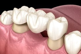 dental bridge 