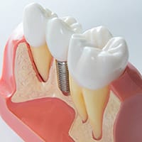 Dental implant illustration