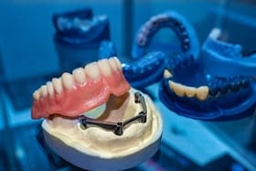 model of implant-retained dentures