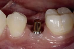 implant patient 1