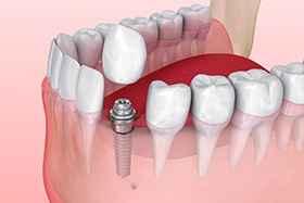 Digital illustration of getting dental implants in Dallas