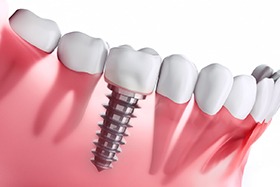 digital illustration of dental implants in Dallas