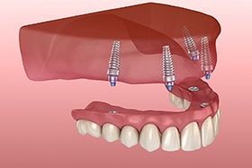 Digital diagram of an implant denture in Dallas