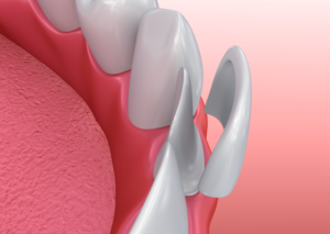 Model of veneer for lower tooth